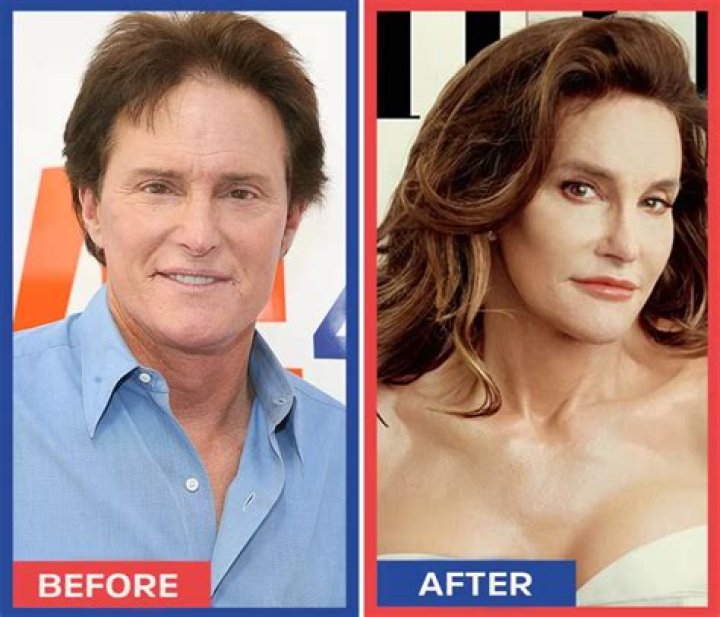 [PICS] Bruce Jenner’s Plastic Surgery — A Scary Facial Transformation – Hollywood Life