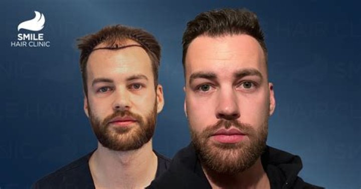 Istanbul Is the Best Place for Hair Restoration in Turkey for Hair Transplantation