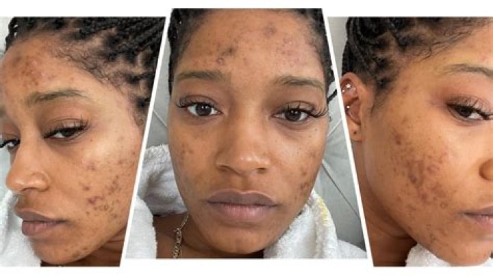 Keke Palmer Makeup Free In Adult Acne Rant Video: Watch – Hollywood Life