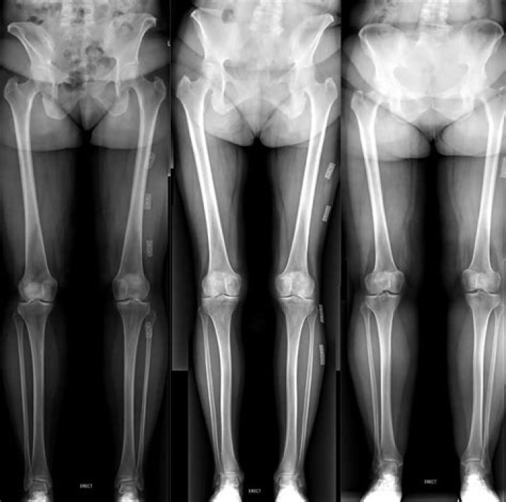 Kevin Ware X-Ray — Extent Of Leg Injury Revealed – Hollywood Life