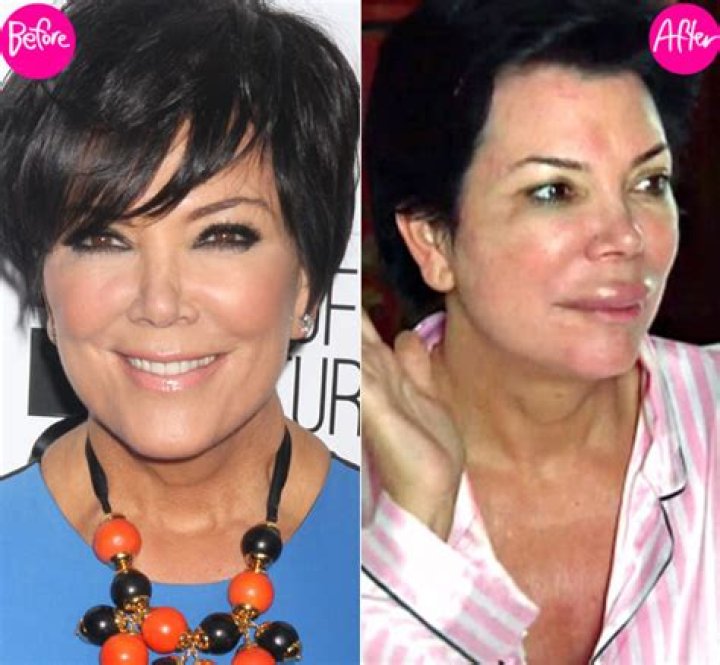 Kris Jenner's Gigantic Swollen Lips — Plastic Surgery Or Allergic Reaction?