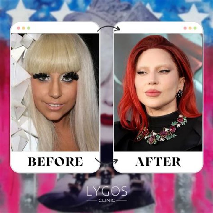 [PICS] Did Lady Gaga Get A Nose Job? Plastic Surgeon Speaks After ‘X Factor’ – Hollywood Life
