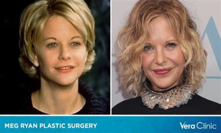 Meg Ryan Addicted To Plastic Surgery? — She’s Gone Over The Top – Hollywood Life