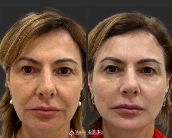 The New Non-Surgical Celebrity Facelift That You Can Get Too