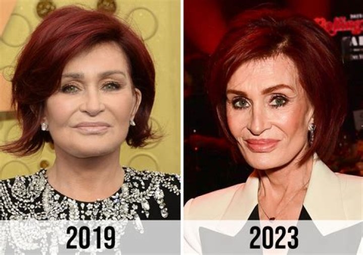 Sharon Osbourne Confesses She Can ‘Hardly Feel’ Her Mouth Anymore After Latest Facelift