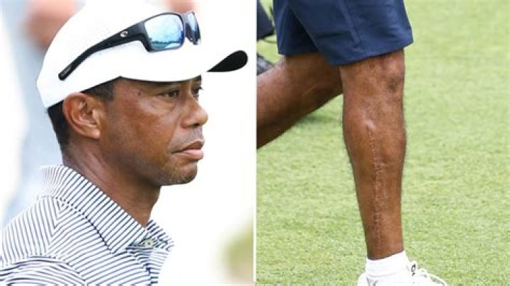 Tiger Woods In ‘Good Spirits’ After Having 2nd Surgery Done On Leg Post-Crash: It Was ‘Successful’